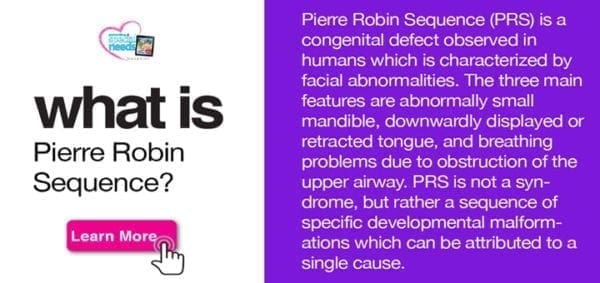 pierre robin sequence awareness day